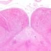 25A1 (Case 25) A8 Gracile NAD 2X