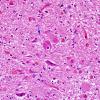 3 Neuroaxonal Dystrophy, gracile (AD, Case 26) H&E 2