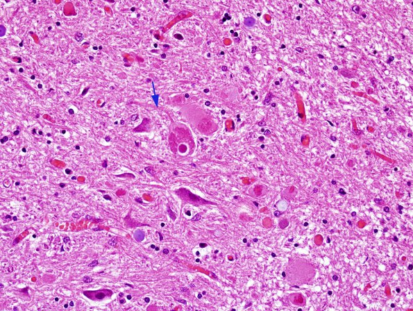 3 Neuroaxonal Dystrophy, gracile (AD, Case 26) H&E 2