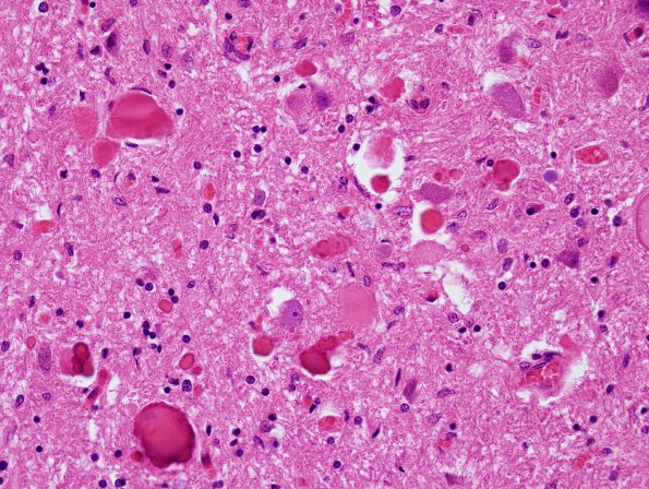 4 Neuroaxonal Dystrophy, gracile (Case 21) H&E 1 (2)