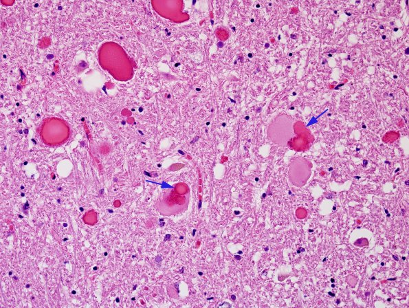 5 Neuroaxonal dystrophy, gracile (Case 25) H&E 40X 3