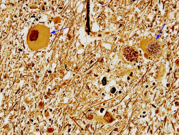 6 Neuroaxonal Dystrophy, gracile, 80yo (Case 6) N12 Biels 4