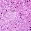 7 Neuroaxonal dystrophy, gracile nucleus (Case 29) H&E 1