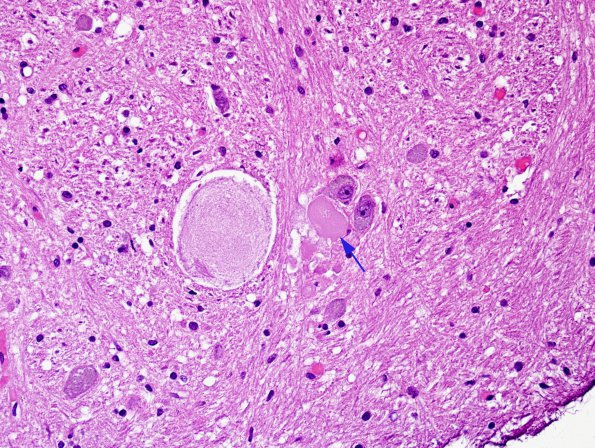 7 Neuroaxonal dystrophy, gracile nucleus (Case 29) H&E 1