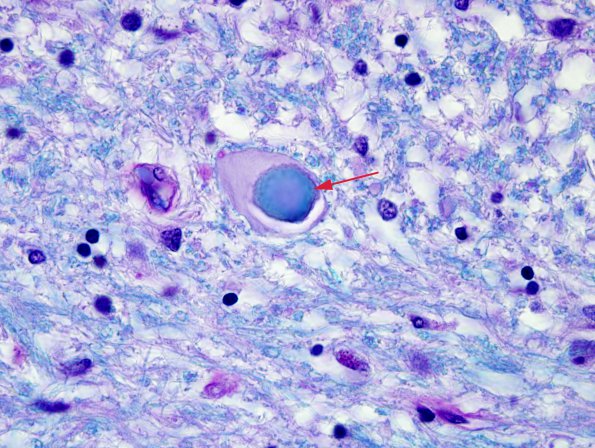 8 Neuroaxonal dystrophy (Case 1) N8 LFB-PAS 6