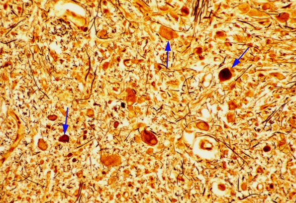 9 Axon, Spheroids, Bielschowsky, Gracile