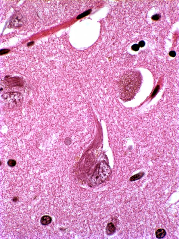 1A1 Neurofibrillary tangle (Case 3) 1 H&E 1