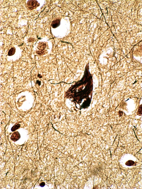 1A2 Neurofibrillary tangle (Case 3) 2 Biels 1