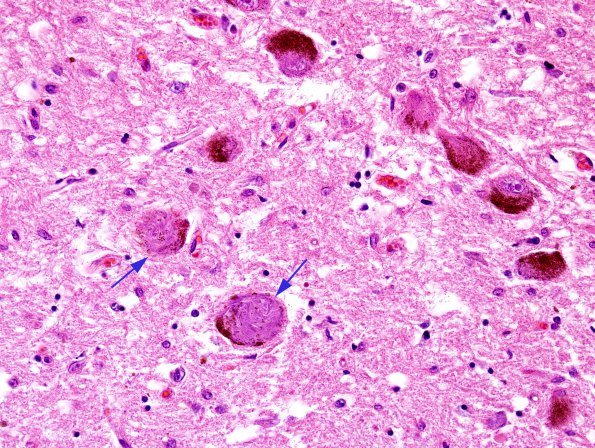 2A1 Neurofibrillary tangle, globose (Case 4) LC H&E 100X 4