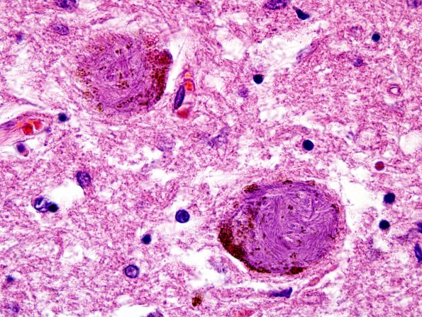 2A2 Neurofibrillary tangle, globose (Case 4) LC H&E 100X 1