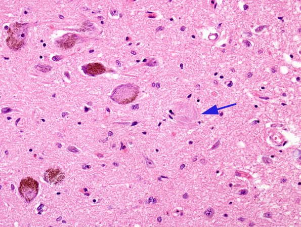 3 Neurofibrillary tangle, globose ghost LC (Case 5)