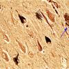 5 Neurofibrillary tangle (Case 2)