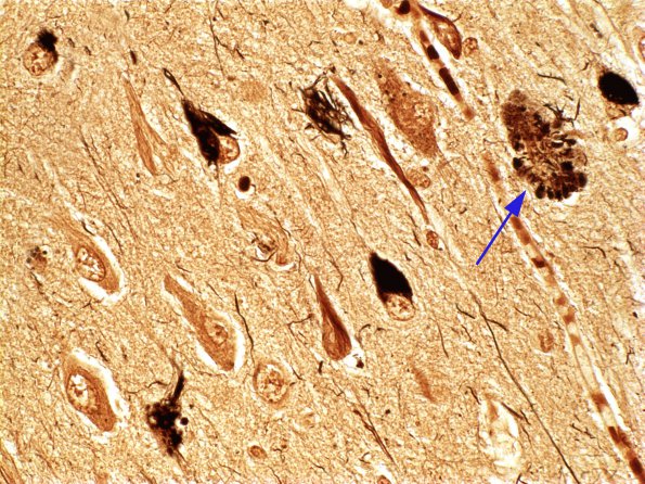 5 Neurofibrillary tangle (Case 2)