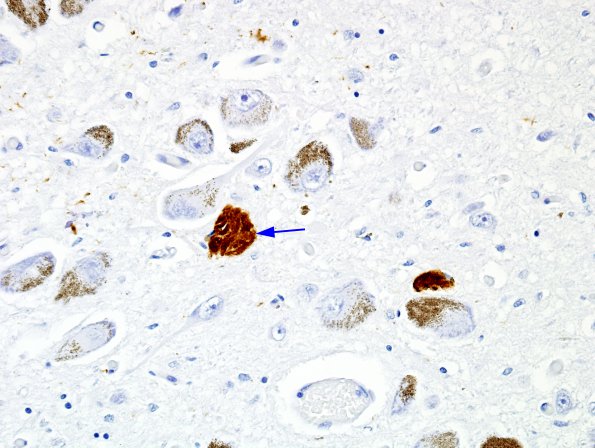 6 Locus Ceruleus, neurofibrillary tangle (Case 1) PHF