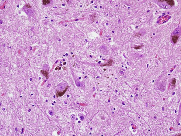 1 Neuromelanin, adult, neurons & macrophages (Case 2) H&E