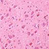 2A1 Neuromelanin, early (7 yo patient, Case 1) Locus C H&E 1