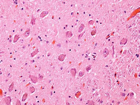 2A1 Neuromelanin, early (7 yo patient, Case 1) Locus C H&E 1