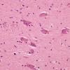 2A2 Neuromelanin, early (7 yo patient, Case 1) SNigra H&E 1