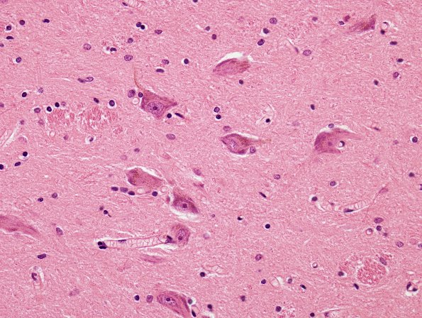 2A2 Neuromelanin, early (7 yo patient, Case 1) SNigra H&E 1