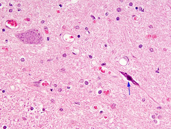 1A1 Atrophy, ALS motoneuron (Case 1) H&E 1