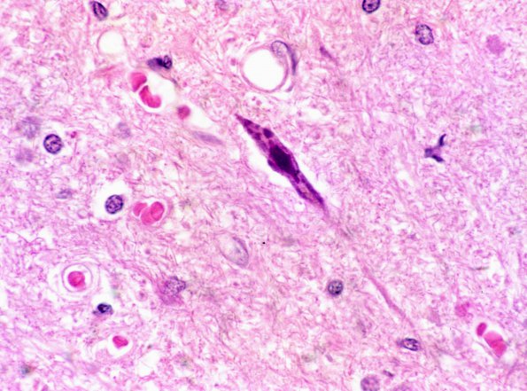 1A2 Neuron, atrophy, (Case 1) ALS H&E 2