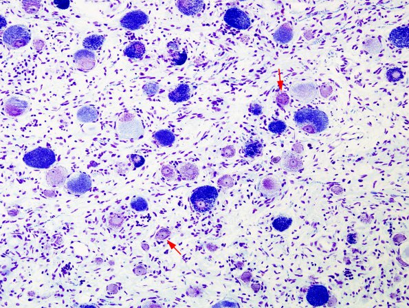 1A1 Neuron, Storage disorder, NOS (Case 1) 1