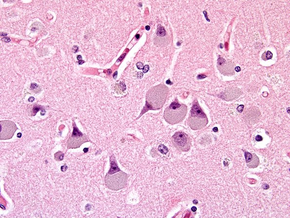 2A1 Neuronal Ceroid Lipofuscinosis (Case 3) N1 H&E 3