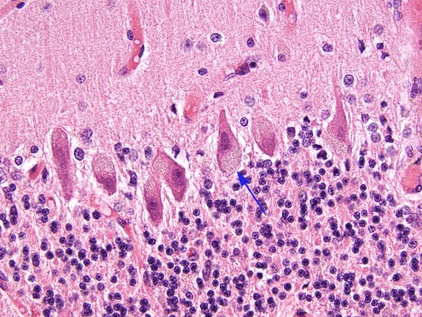 2A2 Neuronal Ceroid Lipofuscinosis (Case 3) N1 H&E 3