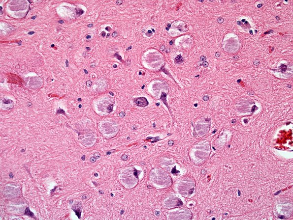 3 Mucopolysaccharidosis VII (1) N3 CA4 1