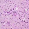 1B Encephalitis, paraneoplastic (Case 1) Medulla 1