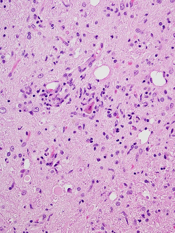 1B Encephalitis, paraneoplastic (Case 1) Medulla 1