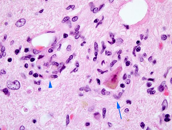 1C Encephalitis, paraneoplastic (Case 1) Medulla 6 copy