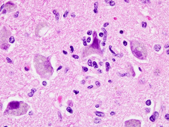 1D Encephalitis, paraneoplastic (Case 1) Medulla 3