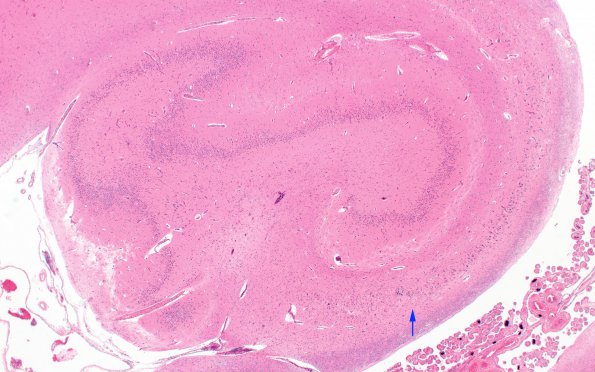 2A Paraneoplastic anti-Hu (Case 2) Hippocampus 4 copy