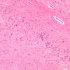 2B Paraneoplastic anti-Hu (Case 2) Hippocampus 20X