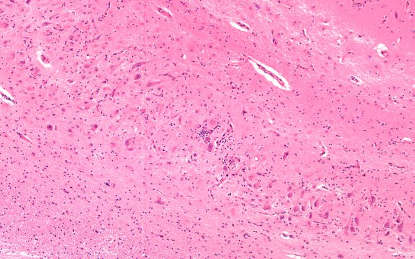 2B Paraneoplastic anti-Hu (Case 2) Hippocampus 20X