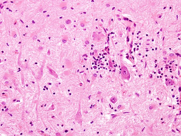 2C Paraneoplastic anti-Hu (Case 2) Hippocampus 1