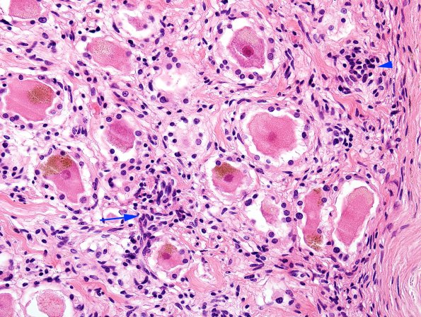 2E Paraneoplastic NP (Case 2) anti-Hu DRG H&E 3 copy