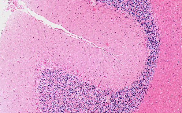 3A Paraneoplastic cerebellar degeneration (Case 3) H&E 1