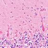 3B Paraneoplastic cerebellar degeneration (Case 3) H&E 4 copy