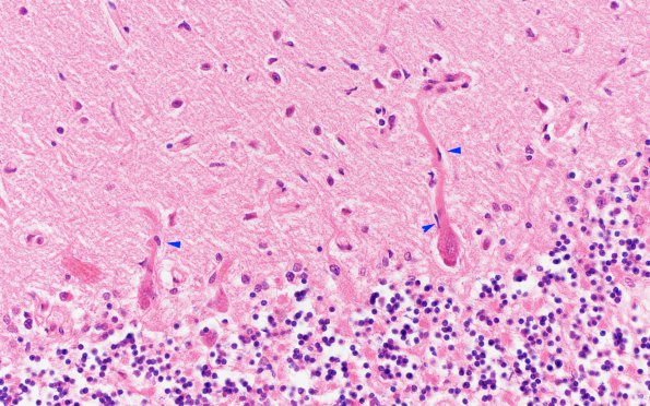 3B Paraneoplastic cerebellar degeneration (Case 3) H&E 4 copy