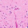 3C Paraneoplastic cerebellar degeneration (Case 3) H&E 3