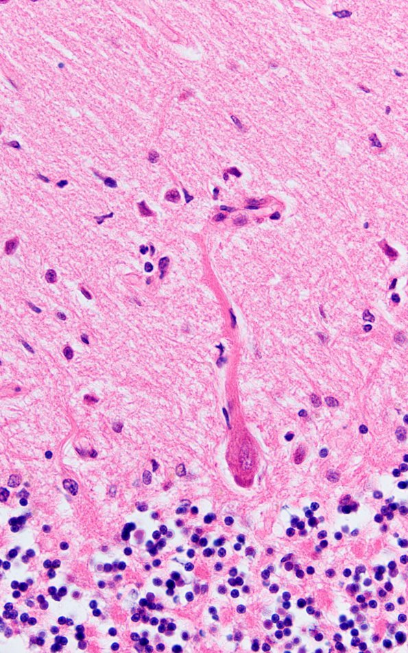 3C Paraneoplastic cerebellar degeneration (Case 3) H&E 3