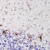 3D Paraneoplastic cerebellar degeneration (Case 3) CD45 3