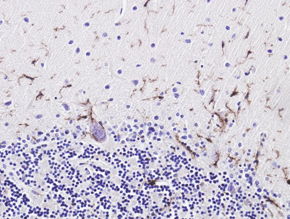 3E Paraneoplastic cerebellar degeneration (Case 3) CD45 2