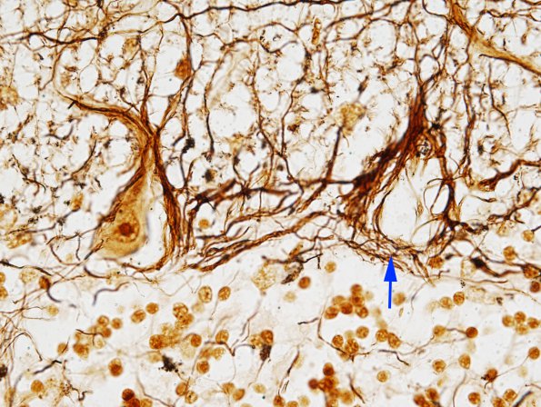 3G Neuron Loss, Empty Baskets (Case 3) 1 copy