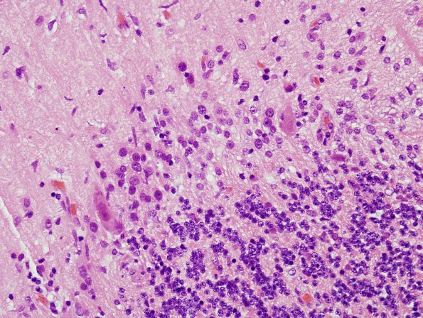 4A Paraneoplastic Cerebellar Degen (Case 4) H&E 1