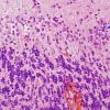 4B Paraneoplastic Cerebellar Degen (Case 4) H&E 2 copy