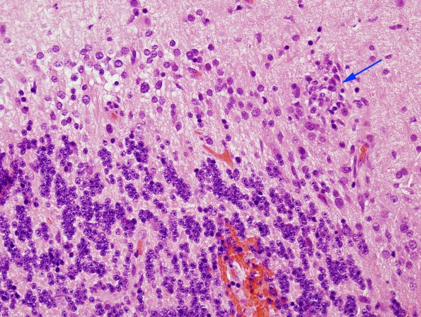 4B Paraneoplastic Cerebellar Degen (Case 4) H&E 2 copy