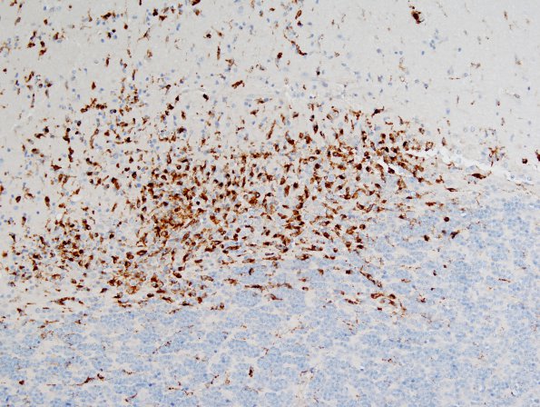 4D Paraneoplastic Cerebellar Degen (Case 4) CD68 4